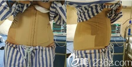 李正强腰腹吸脂手术术后即刻