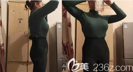 腰腹抽脂术后2个月恢复效果