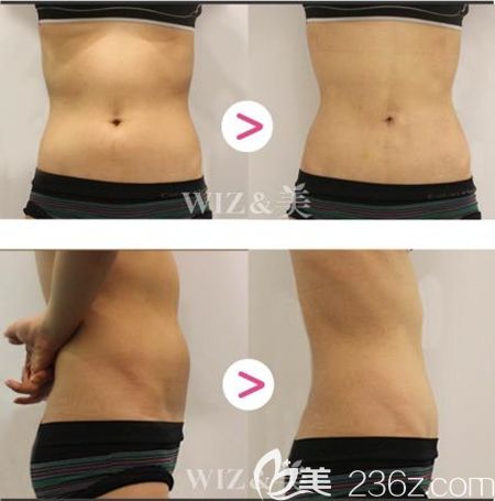 韩国WIZ美迷你吸脂针注射腰腹案例 韩国WIZ美迷你吸脂针注射腰腹案例