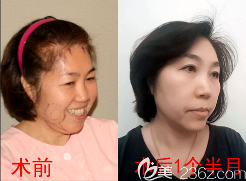 韩国自体脂肪面部填充+眼周年轻化案例