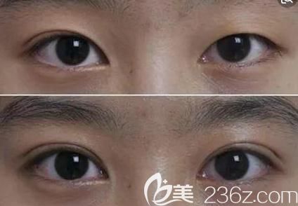 双眼皮手术