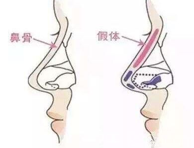 隆鼻手术(假体隆鼻(L型・I型))