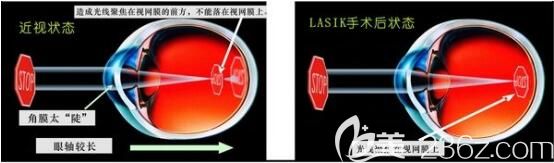 医院整形美容科张彩云激光矫正近视 医院整形美容科张彩云激光矫正近视