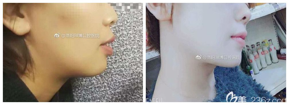 洛阳拜博口腔的真人矫正案例 洛阳拜博口腔的真人矫正案例