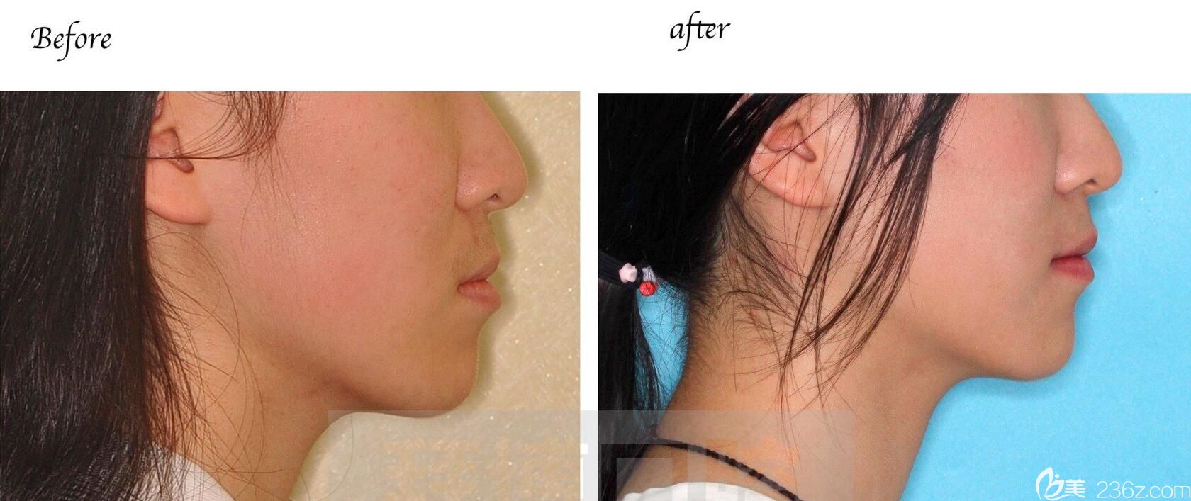 洛阳拜博口腔又一个牙套美女毕业啦 洛阳拜博口腔又一个牙套美女毕业啦