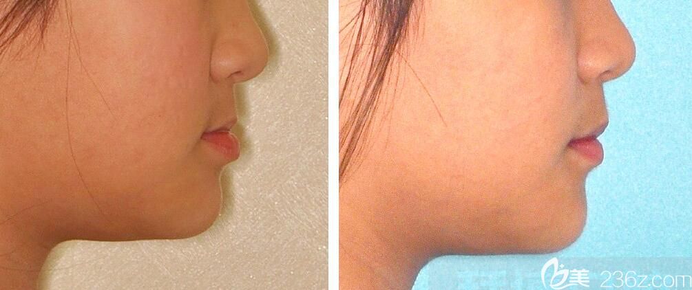 10岁小女生地包天矫正后变开朗自信 10岁小女生地包天矫正后变开朗自信