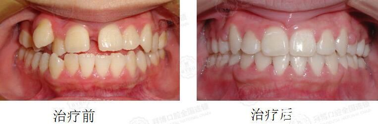 拜博口腔小妹妹牙齿拥挤不齐,双颌前突矫正案例前后对比 拜博口腔小妹妹牙齿拥挤不齐,双颌前突矫正案例前后对比
