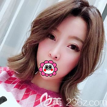 以前一直注射玻尿酸，这次到哈尔滨臻美找院长用自体脂肪+PRP填充全脸看效果怎么样