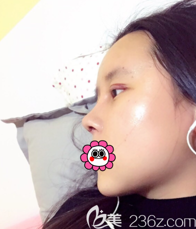 巩敏医生给我做眼综合和鼻综合第3天样子 巩敏医生给我做眼综合和鼻综合第3天样子