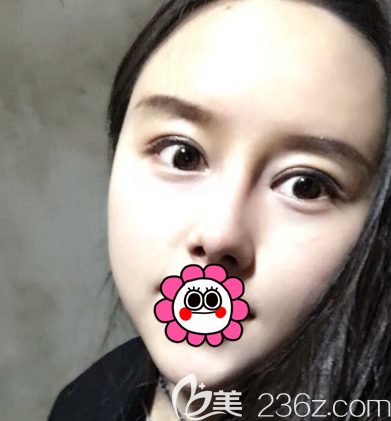 在北京艺美做眼综合和鼻综合第38天效果 在北京艺美做眼综合和鼻综合第38天效果