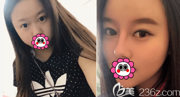 北京艺美巩敏医生眼综合和鼻综合案例 北京艺美巩敏医生眼综合和鼻综合案例