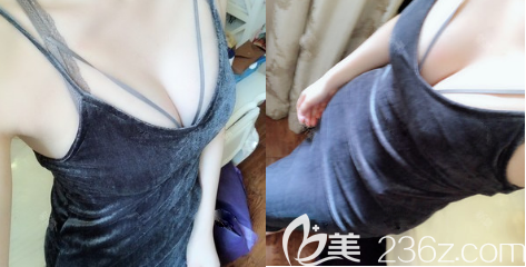 <i data-id='886cabca-d73c-4ec2-aad1-c9bb00ca5f38' style='display:none;'></i>蒲小兵自体脂肪丰胸一年效果