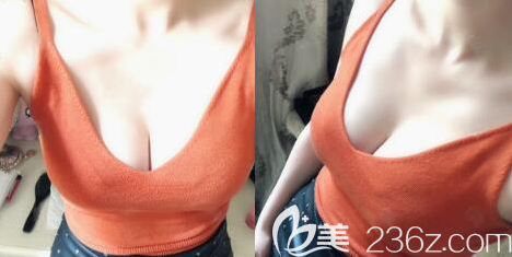 自体脂肪丰胸术后3个月效果图