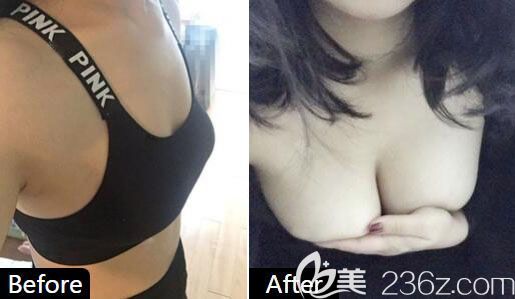 韩国魔笛motiva假体隆胸案例效果对比图