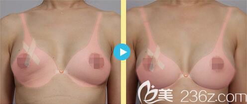 韩国麦恩假体隆胸失败修复真人案例