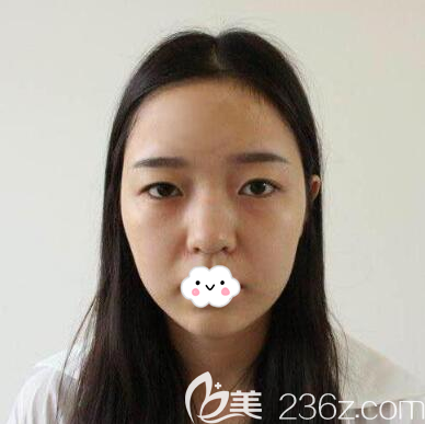 眼鼻整形手术前照片 眼鼻整形手术前照片