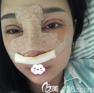 钟正强做眼睛鼻子术后即刻照 钟正强做眼睛鼻子术后即刻照