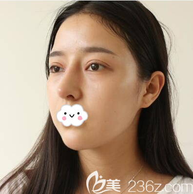 切开双眼皮+鼻综合术后9天恢复图 切开双眼皮+鼻综合术后9天恢复图