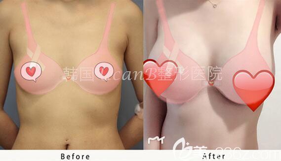 韩国ucanb隆胸怎么样？金骏昊院长贝拉假体隆胸案例