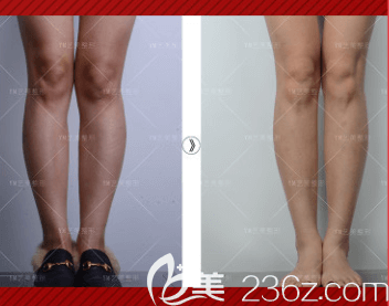 北京艺美王东医生O型腿矫正案例