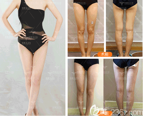 北京润美玉之光王明利医生O型腿矫正案例