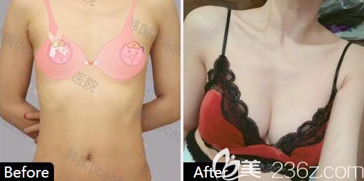 韩国魔滴芯片假体隆胸UcanB金骏昊院长案例