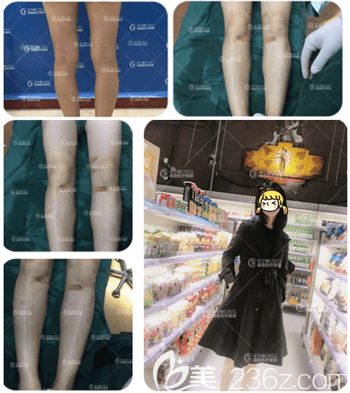 北京卓颜蕊丽赵禹翔OX型腿矫正案例