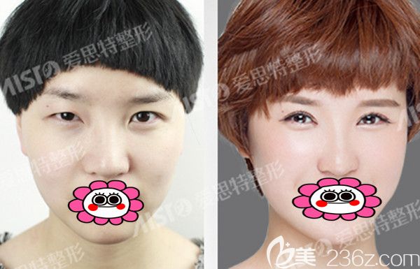 <!--<i data=20240703-sp></li>
<li><i data=20240703-sp></i>-->双眼皮案例