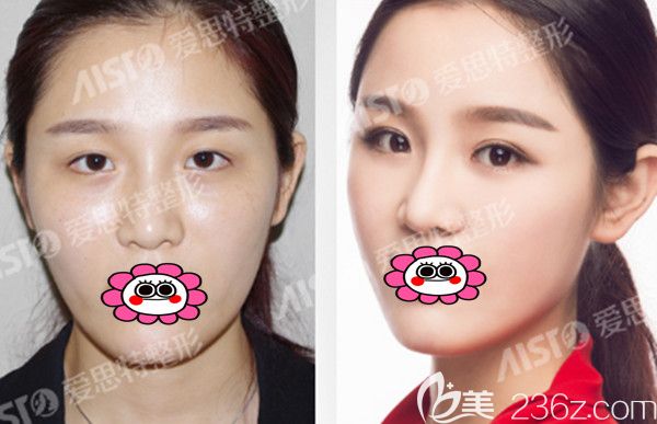 双眼皮前后变化图 双眼皮前后变化图