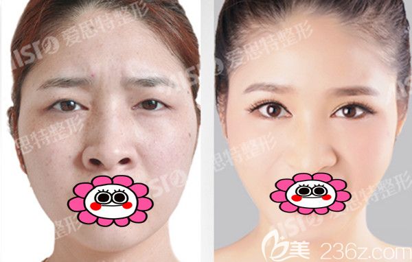爱思特双眼皮前后效果图 爱思特双眼皮前后效果图