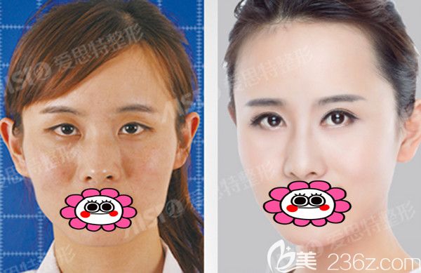 双眼皮前后对比照片 双眼皮前后对比照片