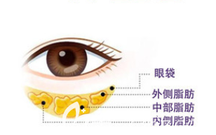 眼袋示意图