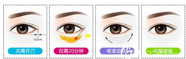 不开刀祛眼袋手术示意图