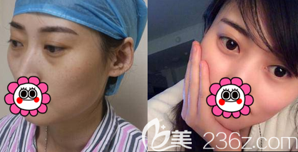 不开刀祛眼袋案例