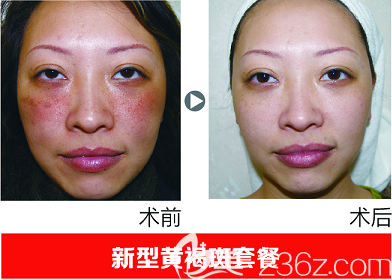 张祛黄褐斑案例 张祛黄褐斑案例