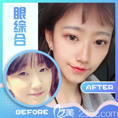梅州曙光整形医院双眼皮案例 梅州曙光整形医院双眼皮案例