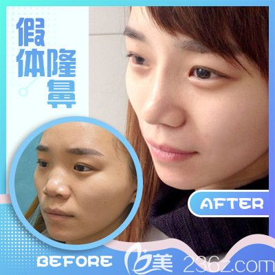 梅州曙光整形医院隆鼻手术案例 梅州曙光整形医院隆鼻手术案例