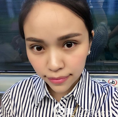 朱武根院长美杜莎综合美眼术后7天效果 朱武根院长美杜莎综合美眼术后7天效果