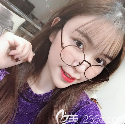 深圳米兰柏羽双眼皮和脂肪填充术后一个月 深圳米兰柏羽双眼皮和脂肪填充术后一个月