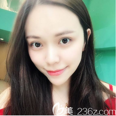 朱武根做的美杜莎双眼皮和脂肪填充两个月案例图 朱武根做的美杜莎双眼皮和脂肪填充两个月案例图