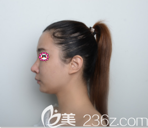 在北京艺美做鼻部异物取出第2天样子