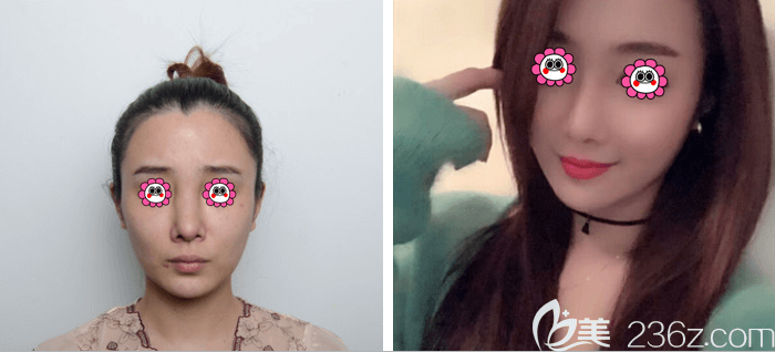 北京艺美范宪红医生鼻部异物取出前后对比效果