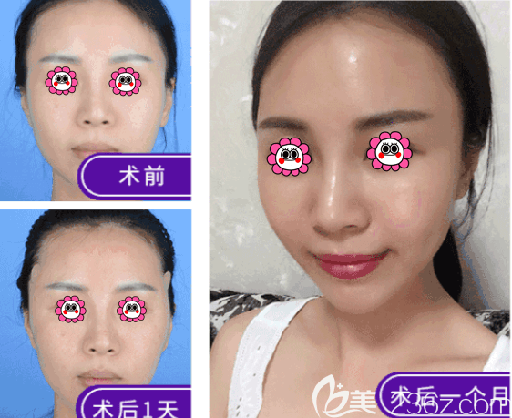 北京艺美王东医生太阳穴生长因子取出修复案例 北京艺美王东医生太阳穴生长因子取出修复案例