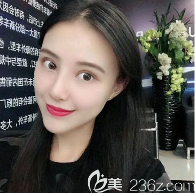 深圳米兰柏羽鼻翼缩小术后半个月效果图 深圳米兰柏羽鼻翼缩小术后半个月效果图