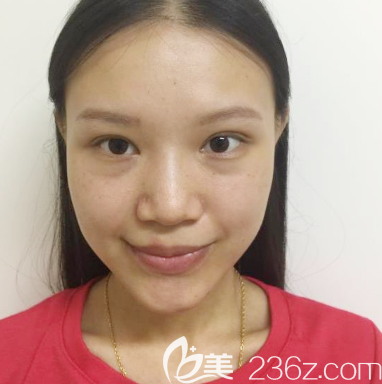在深圳米兰柏羽做鼻翼缩小手术前的照片 在深圳米兰柏羽做鼻翼缩小手术前的照片