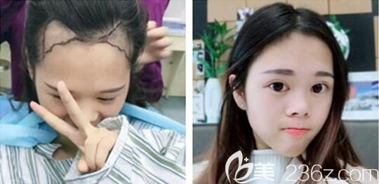 贵州利美康王昌林发际线种植 贵州利美康王昌林发际线种植