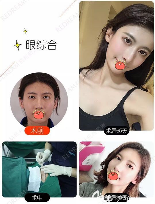 杭州薇琳索慧君割双眼皮案例 杭州薇琳索慧君割双眼皮案例