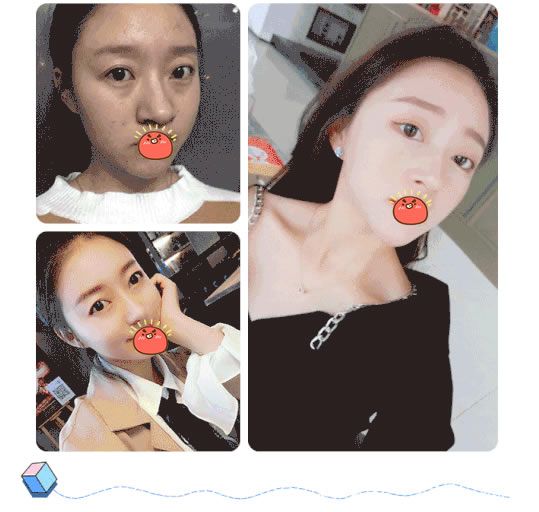 杭州薇琳医院文章隆鼻案例 杭州薇琳医院文章隆鼻案例