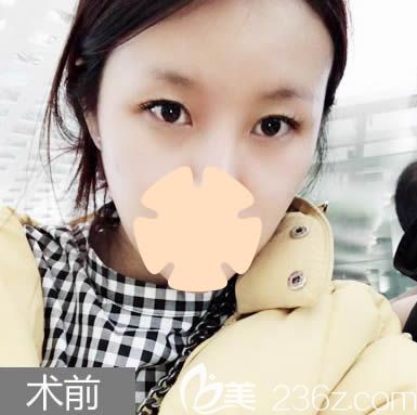 长春中妍做双眼皮案例效果 长春中妍做双眼皮案例效果