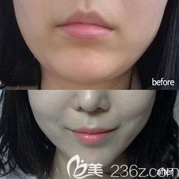 崔永泽院长注射瘦脸案例 崔永泽院长注射瘦脸案例